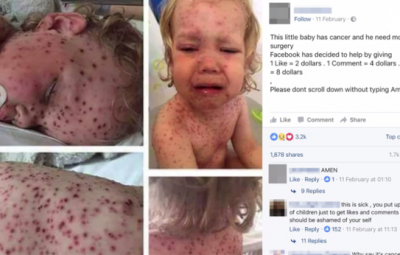 toddler's chicken pox photos